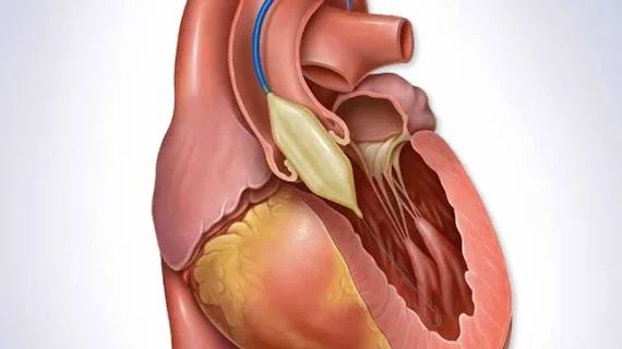 Balloon valvuloplasty months after implantation is a safe and effective treatment option for patients with transcatheter heart valve (THV) dysfunction, according to a new analysis published in the Journal of the American College of Cardiology
