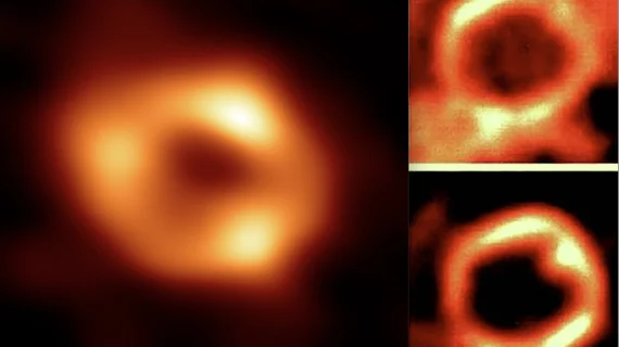 A comparison on the black hole at the center of the Milky Way galaxy (left) with PET cardiac myocardial perfusion nuclear imaging exams (right).  The cardiac diagnosis of the galactic heart is motion artifact. Black hole image from the EHT Collaboration