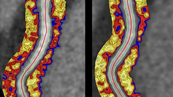 xPerivascular fat attenuation index CT scans from a drug study showing a reduction in coronary wall inflammation. This measure is being tested in trials to see if it can accurately predict which coronary artery lesions will progress to cause heart attacks. The method also can show a reduction in risk with therapy, as seen here.