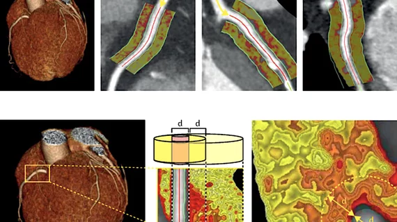 Perivascular fat attenuation index CT scans showing the amount coronary wall inflammation. This measure is being tested in trials to see if it can accurately predict which coronary artery lesions will progress to cause heart attacks. 