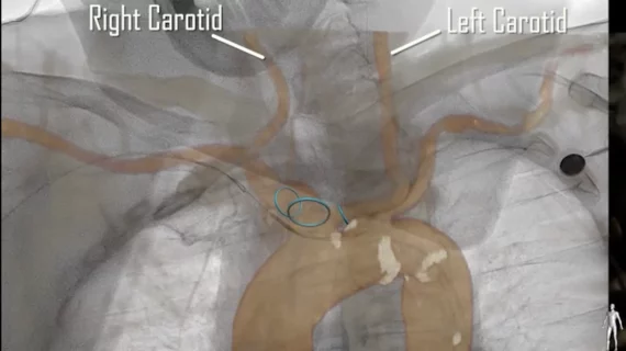 transcatheter aortic valve replacement (TAVR) procedure guided by CT fusion imaging on a patient with heart failure and a blood clot. CT fusion imaging-guided deployment of the Sentinel Cerebral Protection System during a TAVR procedure. Image courtesy of Vasudev et al.