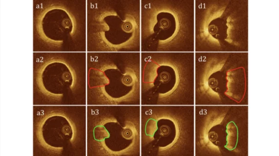 . Plaque erosion detection by the proposed AI algorithm in four cases, with each column showing one case. From top to bottom are the original images, ground truth, and predicted plaque erosion by our proposed method respectively.