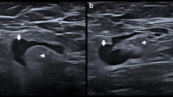 differentiating between malignant and vaccine-related lymphadenopathy