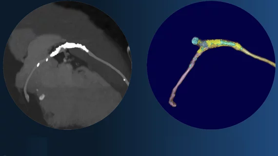 Left, coronary CT angiography of a vessel showing plaque heavy calcium burden. Right, image showing color code of various types of plaque morphology showing the complexity of these lesions. The right image was processed using the FDA cleared, AI-enabled plaque assessment from Elucid.