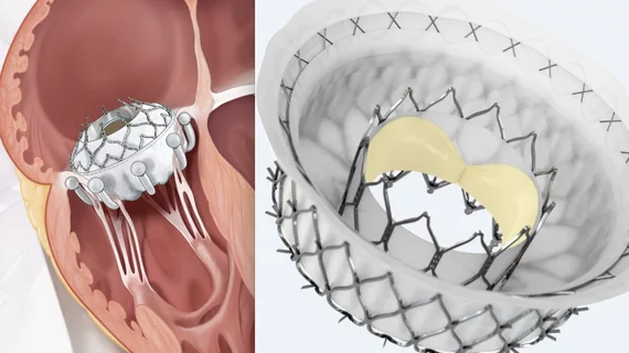 Mitral and_tricuspid transcatheter valves Evoque and Intrepid were discussed at TVT 2022.