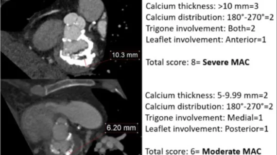 Mitral annular calcium (MAC) does not appear to have a negative effect on long-term transcatheter aortic valve replacement (TAVR) outcomes, according to new research published in the American Journal of Cardiology.