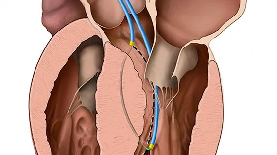 Adam Greenbaum, MD, transcatheter electrosurgery to prevent left ventricular outflow tract (LVOT) obstruction using a new procedure called Septal Scoring Along the Midline Endocardium (SESAME). The transcatheter procedure mimicking surgical myotomy.