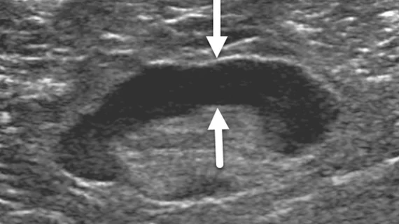 COVID_Vaccine_Lymph_adenopathy_Breast_Ultrasound.jpeg