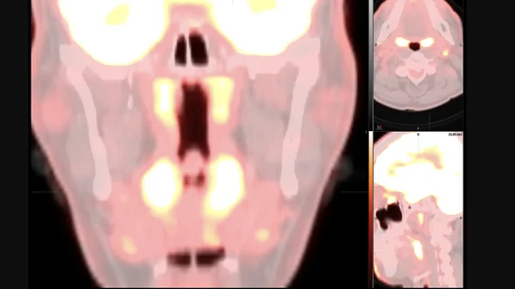 SNMMI images of unusual imaging pattern observed on FDG PET/CT or FDG PET/MR that may be due to Omicron COVID-19 infection. Unlike the FDG PET/CT pattern seen with infections from previous strains of COVID-19, with principal involvement of the lungs, this new array of findings is primarily centered in the upper aerodigestive tract and cervical lymph nodes. What does omnicron COVID look like in medical imaging?