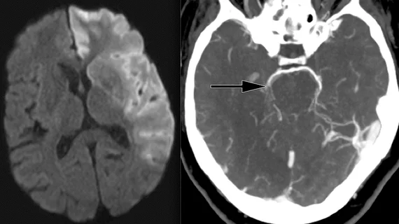 Ischemic stroke shown in CT scans. Image courtesy of RSNA