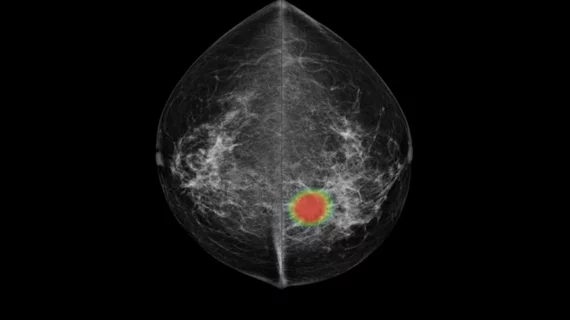 Example of a radiology diagnostic aid artificial intelligence (AI) algorithm with Lunit's mammography cancer lesion detection system.
