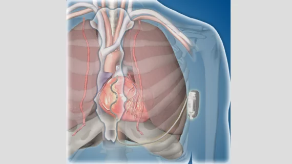 Medtronic shared some good news with attendees at ESC Congress 2022 in Barcelona, the annual meeting of the European Society of Cardiology, noting that its Extravascular Implantable Cardioverter Defibrillator (EV ICD) system met its safety endpoints in a global clinical trial. Medtronic EV ICD clinical trial safety endpoints ESC Congress 2022 #ESC #ESC2022 #ESC22