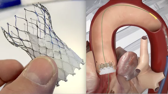 The Medtronic CoreValve Evolut and the Edwards Lifesciences Sapien 3 TAVR valves.