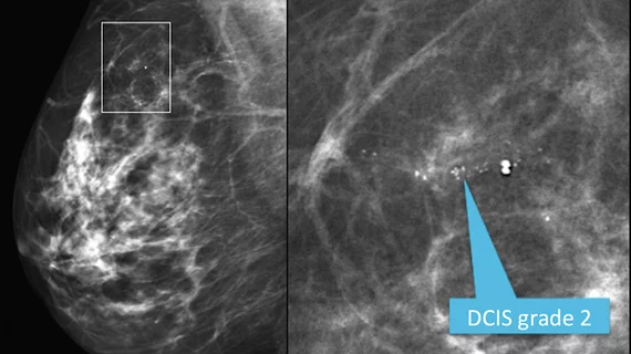 Mediolateral oblique view from a screening mammogram in a 54-year-old woman shows a small cluster of microcalcifications in the upper outer quadrant of the right breast. The right image shows a detailed spot magnification view of the calcifications. Stereotactic biopsy revealed grade 2 ductal carcinoma in situ (DCIS). RSNA image. Image of breast micro calcifications associated with breast cancer.