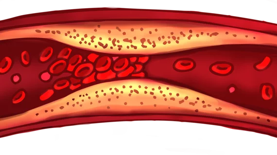 blood_clot.png