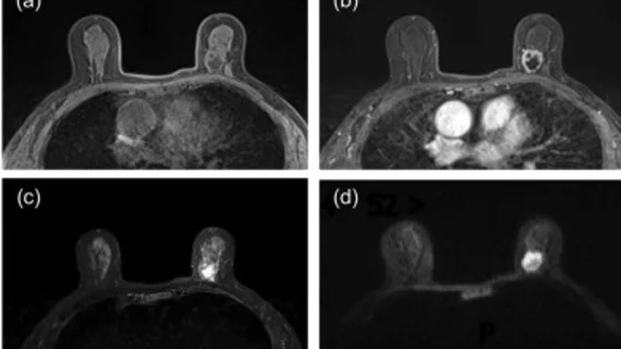 breast MRI metaplastic carcinoma