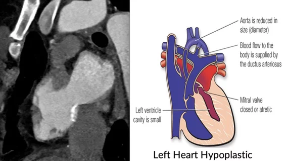CT imaging showing the congenital heart defect of left heart hypoplastic syndrome.