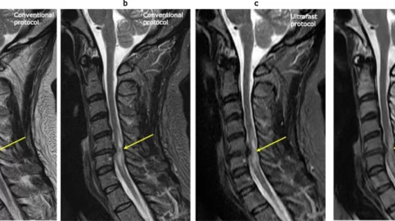 cervical spine mri
