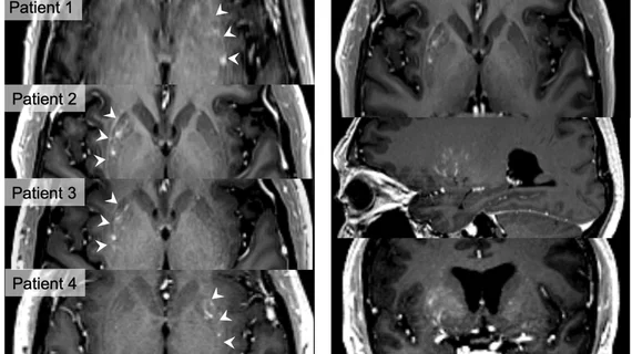 focused ultrasound Parkinson's