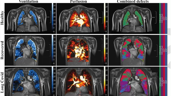 long covid lung damage in children