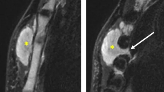 soft tissue lymphoma versus soft tissue tumor