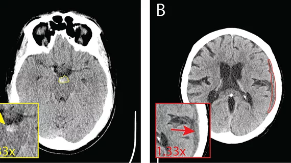 Cureus, ICH on CT