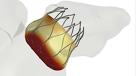 A FEOPS image of a Watchman LAA occluder device being checked for virtual sizing in an anatomical model of the patient's left atrial appendage. Dhanunjaya Lakkireddy, MD, explains the role and technology of LAA closure devices in managing AFib patients. 