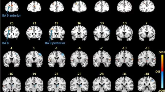 lyme disease on fMRI