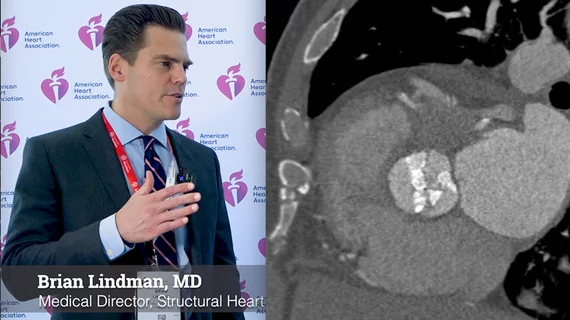Brian Lindman, MD, MSCI, medical director of the Structural Heart and Valve Center and an associate professor of medicine, Vanderbilt University Medical Center, explains the new American Heart Association (AHA) Target Aortic Stenosis (AS) program. It was announced at the AHA 2022 meeting and is designed to help screen with echo to find more AS patients. 
