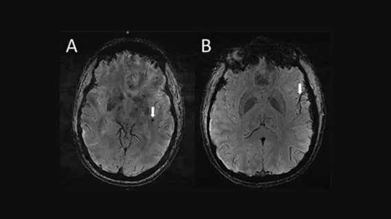 Ultra-high-res MRI Reveals Migraine Brain Changes