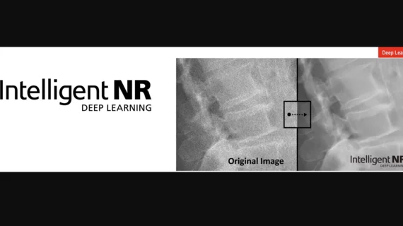 Intelligent NR Canon RSNA 2022