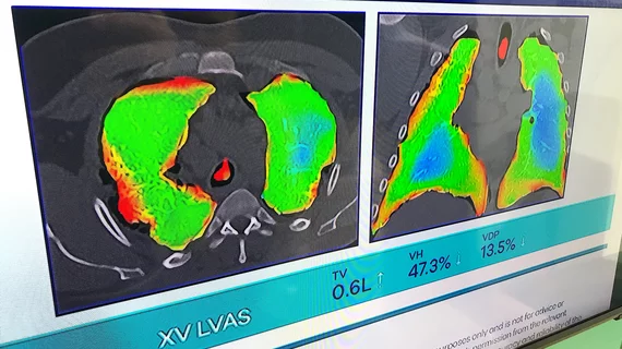 Dynamic lung air flow analysis just using X-ray without any contrast with new technology from 4D Medical.