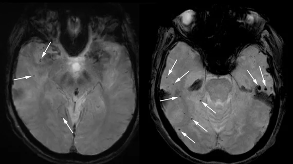 brain scans of woman who died after taking experimental alzheimer's drug