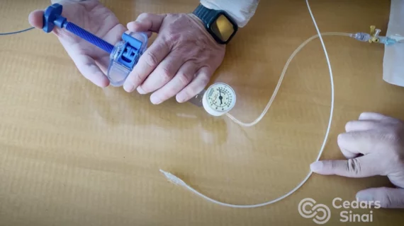 The Minima Stent being demonstrated by Cedars Sinai Hospital. The adjustable stent is designed to grow with children who need cardiac procedures. 