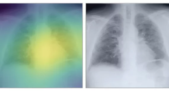 Jakob Weiss, MD, a radiologist affiliated with the Cardiovascular Imaging Research Center at Massachusetts General Hospital and the AI in Medicine program at the Brigham and Women’s Hospital in Boston, helped develop an deep learning AI algorithm that can assess a patient's biological age and risk assess patients for various diseases. #RSNA #AI #ImagingAI 