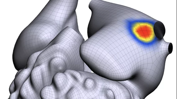 Atrial Fibrillation and its location in the atrium detected using the Vektor arrhythmia detection software. COVID infection can cause the development of AFib, AF, in patients as a long-COVID symptom. 