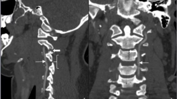 cerebrovascular injury #traumaimaging #vascularimaging #vascularinjury