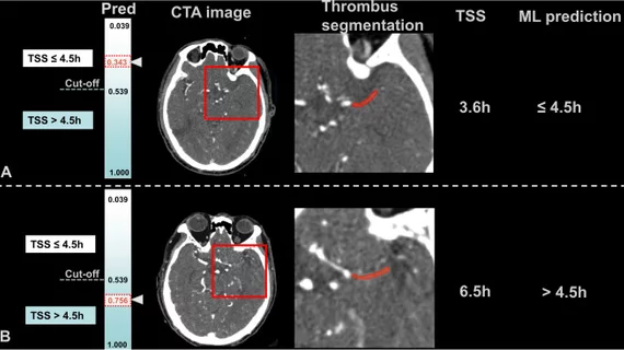 #CTA #acuteischemicstroke #AIS #radiomics