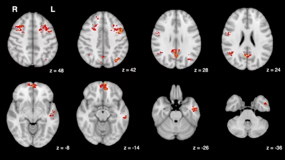 functional MRI brain scan