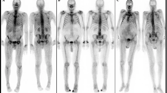 cardiac amyloidosis on bone scan