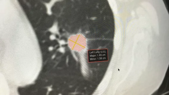 Example of artificial intelligence generated measurements to quantify the size of a lung cancer nodule during a followup CT scan to see if the lesion is regressing with treatment. This type of automation can aid radiologists by doing the tedious, time consuming work. Photo by Dave Fornell