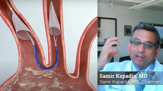 Samir Kapadia, MD, chairman of the Robert and Suzanne Tomsich Department of Cardiovascular Medicine, Sydell and Arnold Miller Family Heart, Vascular and Thoracic Institute at Cleveland Clinic, explains why he believes the results of the late-breaking PROTECTED TAVR testing the use of a TAVR cerebral protection device were positive, although it did not meet its primary endpoint. 