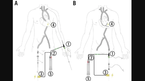 ElectroDucer Sleeve PCI TAVR EuroIntervention