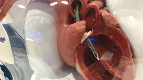 Model in the Abiomed booth showing placement of the Impella 5.5 liters per minute catheter heart pump. This is used for patients who need more support than a conventional Impella CP can offer, but does not require level of supported from ECMO.