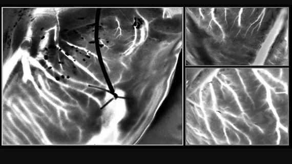 Laser speckle imaging captures details of blood vessels in a beating donor transplant heart outside the body for viability evaluation. Image from Plyer et al., doi 10.1117/1.JBO.28.4.046007