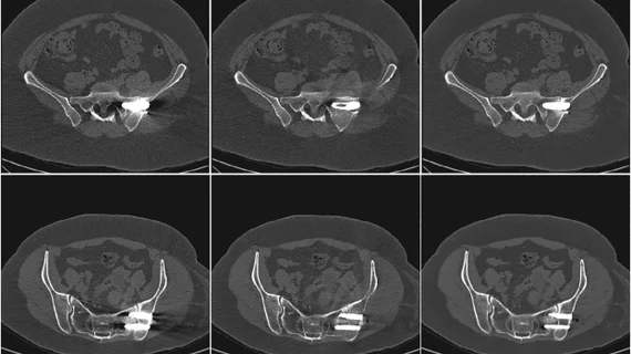 metal artifacts on CT