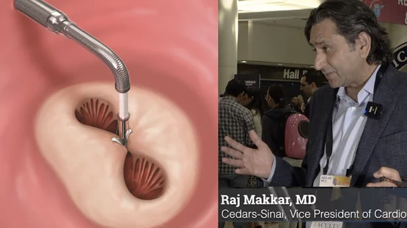 Raj Makkar, MD, Cedars-Sinai’s vice president of Cardiovascular Innovation and Intervention and the Stephen R. Corday, MD, Chair in Interventional Cardiology, explains the ACC 2023 results on the safety and efficacy of transcatheter edge-to-edge mitral valve repair in degenerative mitral regurgitation (MR) study. It was a review of data is from the STS/ACC TVT Registry that was presented at the American College of Cardiology (ACC) 2023 meeting.
