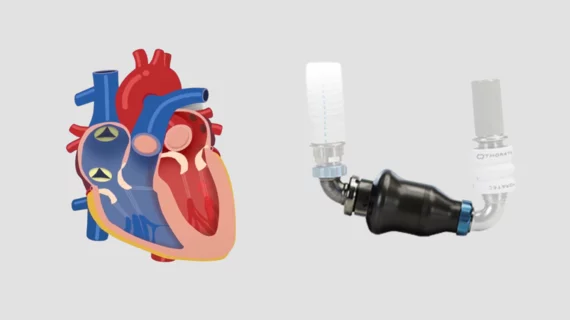 TricValve Transcatheter Bicaval Valves System and HeartMate II LVAD. A team of interventional cardiologists has made a bit of history, using a new transcatheter device to treat tricuspid regurgitation (TR) in a high-risk heart failure patient who with a previously implanted left ventricular assist device (LVAD). It represents the first time this particular device, the TricValve Transcatheter Bicaval Valves System from P+F Products, has been implanted in a patient with this particular LVAD, the HeartMate II.