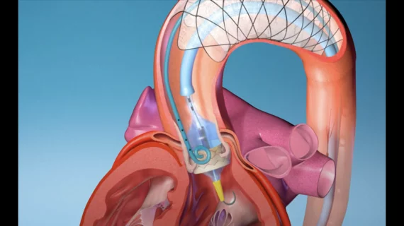 The EnCompass Technologies F2 embolic filter device is designed to limit the risk of stroke and other severe brain injuries during TAVR.