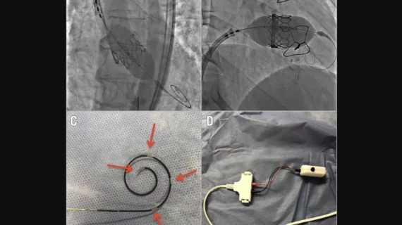 The Wattson temporary pacing guidewire from Teleflex